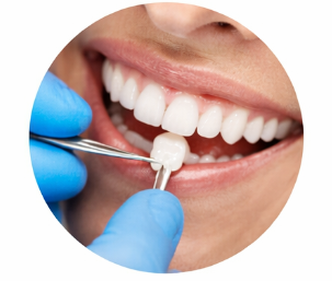 Lentes de Contato Dental